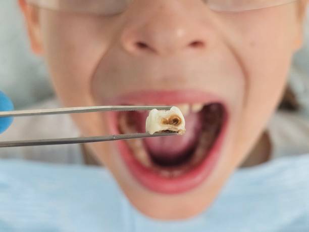 Best Emergency Tooth Extraction in Mill Hall, PA